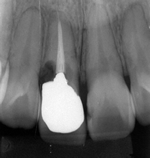 インプラント治療（前歯）
